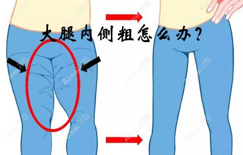 大腿内侧粗怎么办?怎样才能瘦腿?快速有效的方法是大腿抽脂