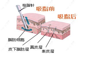 抽脂手术前后对比图解 抽脂手术前后对比图解
