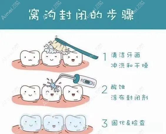 20211216662213.jpg 窝沟封闭的步骤.jpg