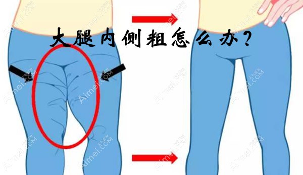 大腿内侧粗怎么办 大腿内侧粗怎么办