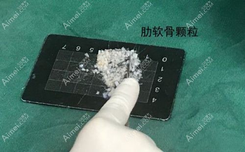 肋软骨颗粒垫鼻基底会导致移位后遗症.jpg