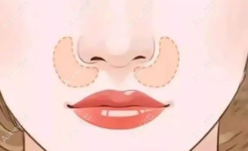 鼻基底凹陷垫肋软骨后悔了.jpg