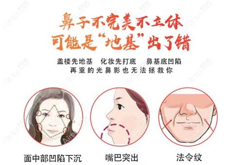 肋软骨垫鼻基底能改善面部凹陷.jpg 肋软骨垫鼻基底能改善面部凹陷.jpg