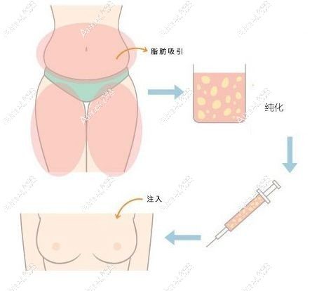 自体脂肪丰胸三四年后有什么危害和副作用分享.jpg 自体脂肪丰胸三四年后有什么危害和副作用分享.jpg