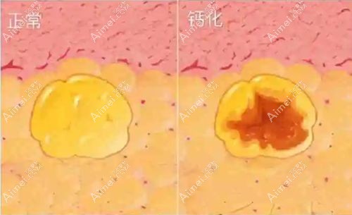 自体脂肪丰胸失败例子由脂肪钙化导致m.dlren.com.jpg 自体脂肪丰胸失败例子由脂肪钙化导致m.dlren.com.jpg
