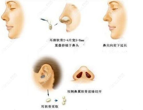 柳叶型假体加耳软骨隆鼻要植皮吗www.dlren.com.jpg