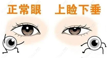 双眼皮术后上睑下垂是双眼皮失败八种表现之一.jpg 双眼皮术后上睑下垂是双眼皮失败八种表现之一.jpg