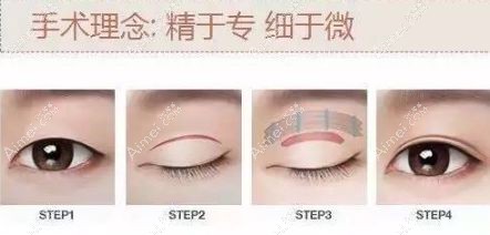 割双眼皮手术失败的八种表现,对照图片看你属于哪种类型?