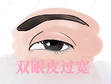 双眼皮失败表现之过宽的双眼皮m.dlren.com.jpg 双眼皮失败表现之过宽的双眼皮m.dlren.com.jpg