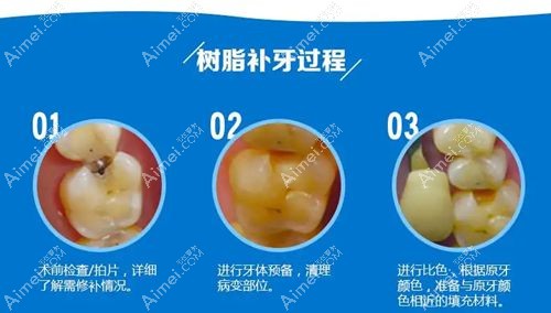牙医用树脂补牙的过程分享m.dlren.com.jpg
