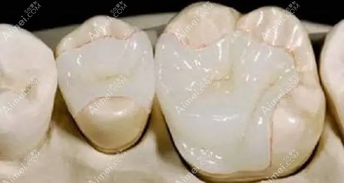 树脂补牙的外观和真实牙齿颜色差不多www.dlren.com.jpg