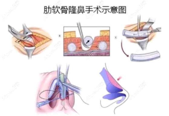 肋软骨隆鼻过程dlren.com 肋软骨隆鼻过程dlren.com