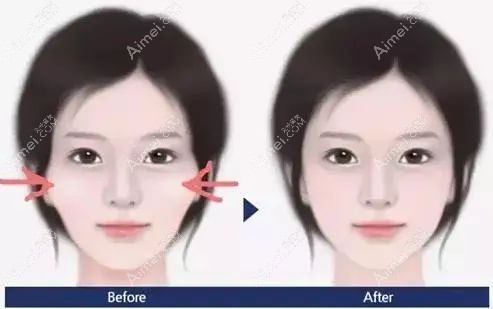 颧弓推了3mm手术实例图片www.dlren.com.jpg 颧弓推了3mm手术实例图片www.dlren.com.jpg