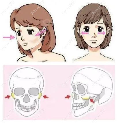 颧骨内推5毫米外观变化蛮大.jpg 颧骨内推5毫米外观变化蛮大.jpg