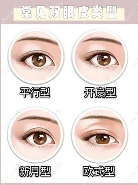平行型双眼皮是4种双眼皮类型之一www.dlren.com.jpg 平行型双眼皮是4种双眼皮类型之一www.dlren.com.jpg
