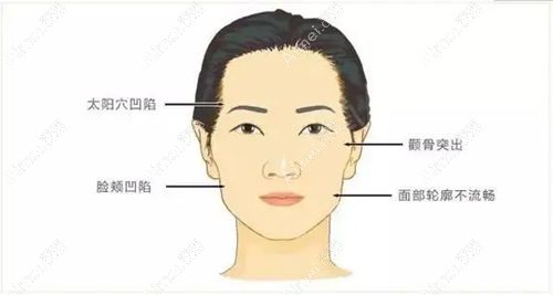 颧弓外扩示意图.jpg 颧弓外扩示意图.jpg