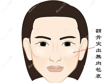 颧骨内推手术是非常可怕吗?它是几级手术?有微创颧骨内推吗