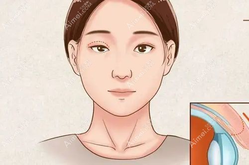 平行和开扇双眼皮区别在于形态和适合脸型不一样www.dlren.com.jpg