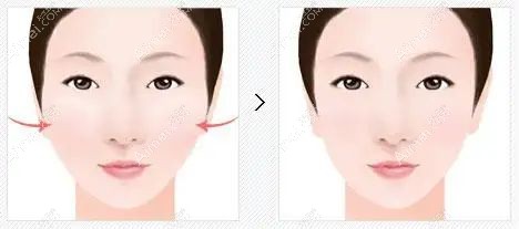 颧骨内推手术前后对比图片m.dlren.com.jpg 颧骨内推手术前后对比图片m.dlren.com.jpg