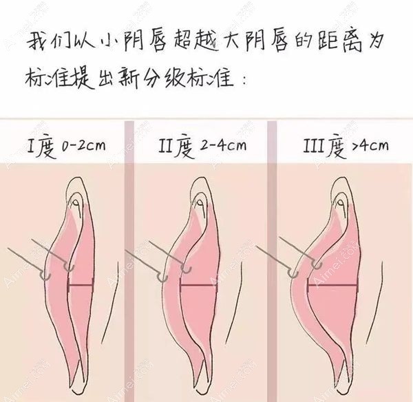 小阴唇整形手术有哪些副作用和危害,逃不开留疤和疤痕增生
