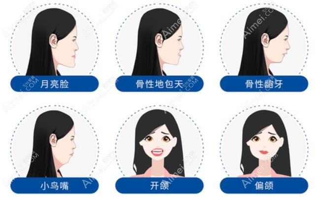 正颌手术后脸型改变图汇总:骨性突嘴/偏颌/地包天改善明显