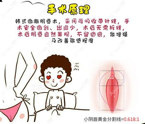 小阴唇手术原理介绍www.aimei.com.jpg 小阴唇手术原理介绍www.aimei.com.jpg