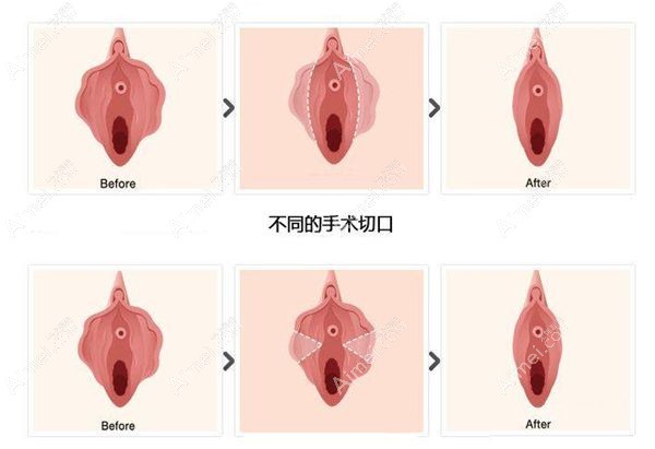 小阴唇整形手术前后对比m.aimei.com.jpg 小阴唇整形手术前后对比m.aimei.com.jpg