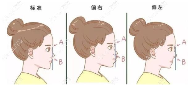 偏颌做正颌手术前后脸型改变图dlren.com 偏颌做正颌手术前后脸型改变图dlren.com