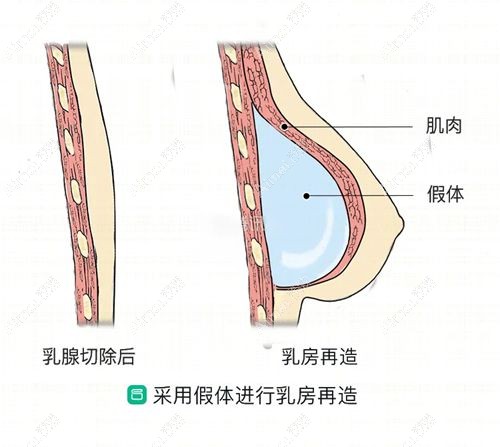 国内乳房再造排名前十医生榜单m.dlren.com.jpg 国内乳房再造排名前十医生榜单m.dlren.com.jpg