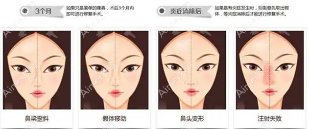 北京鼻修复好的医生是谁?李劲良/牛永敢肋骨鼻修复厉害有名