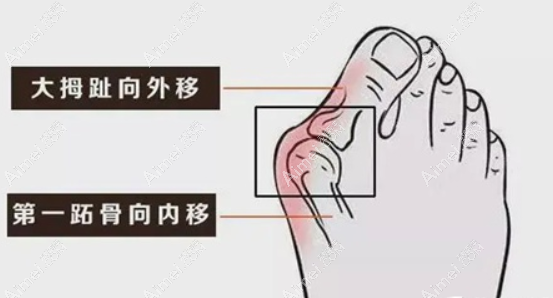 北京圣嘉新大脚骨手术部位dlren.com 北京圣嘉新大脚骨手术部位dlren.com