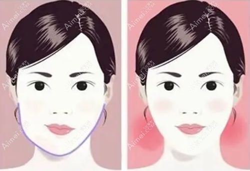 偏颌手术一般5-7mm需要做正颌手术.jpg