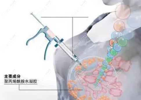 国内奥美定隆胸取出十大医院揭秘：北京煤医/广州荔湾/上海华美清奥干净