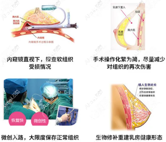 广州市荔湾区人民医院奥美定取出 广州市荔湾区人民医院奥美定取出
