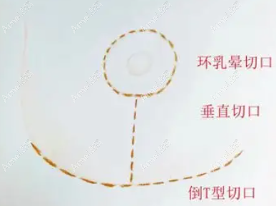 西安画美易成刚医生缩胸切口 西安画美易成刚医生缩胸切口