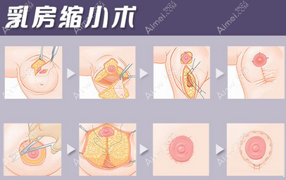 北京美莱高超医生缩胸过程dlren.com 北京美莱高超医生缩胸过程dlren.com