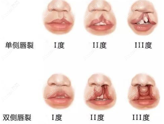 唇裂二期修复医院排名前三:是国内儿童/成人兔唇修复好医院