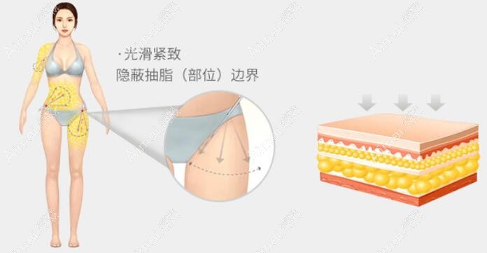 冯斌医生有高清逐层逐行吸脂术 冯斌医生有高清逐层逐行吸脂术