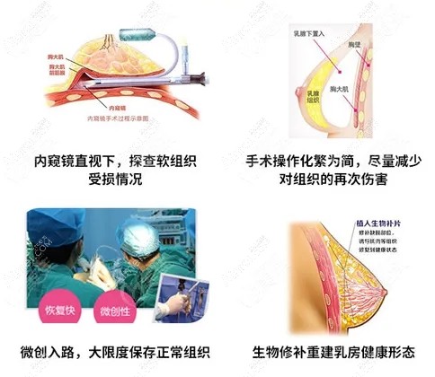 广州中家医家庭医生胸部奥美定取出修复 广州中家医家庭医生胸部奥美定取出修复