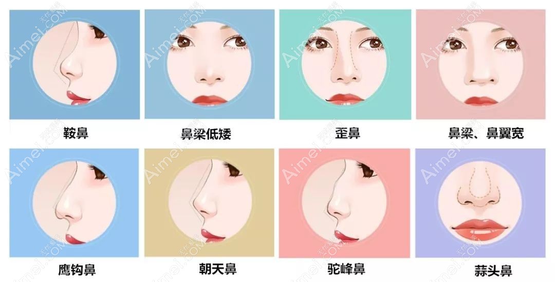 北京沃尔的刘彦军鼻修复类型多dlren.com 北京沃尔的刘彦军鼻修复类型多dlren.com