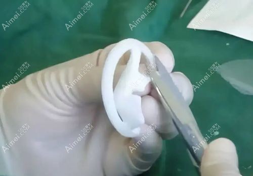 余文林做medpor支架耳再造好www.aimei.com.jpg 余文林做medpor支架耳再造好www.aimei.com.jpg