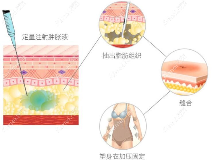 广州军美王世虎吸脂塑性好 广州军美王世虎吸脂塑性好