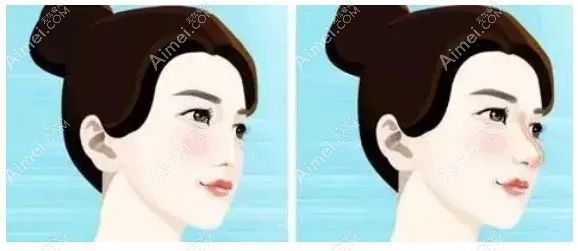 厦门有名的鼻综合医生排名前五中袁纯新做肋骨鼻综合好.jpg 厦门有名的鼻综合医生排名前五中袁纯新做肋骨鼻综合好.jpg