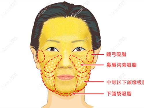 贵阳可以抽脂的正规医院排名前三有推荐面部吸脂好的医生