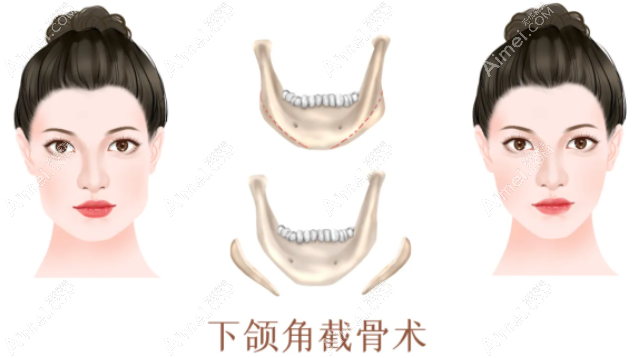 广州韩妃医院柳超下颌角截骨技术怎么样 广州韩妃医院柳超下颌角截骨技术怎么样