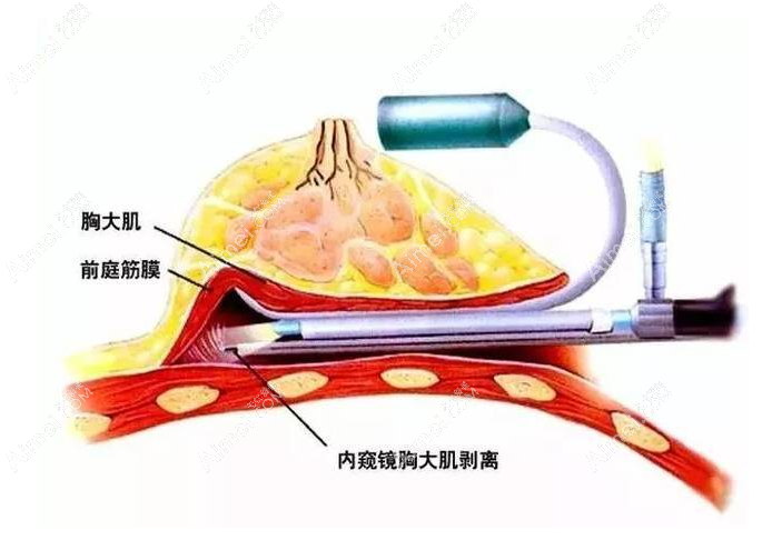 长沙雅美内窥镜隆胸技术好dlren.com
