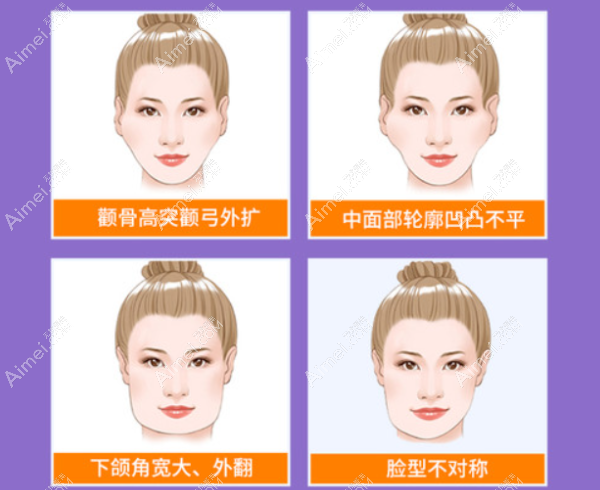 广州磨骨医生排名:何锦泉,柳超和颌面磨骨排行榜前三