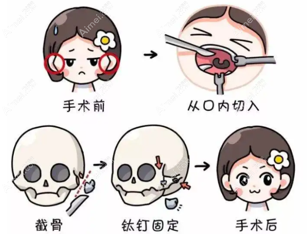 医生颧骨内推手术怎么样 医生颧骨内推手术怎么样