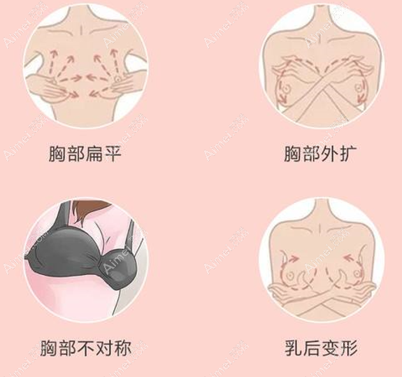 长沙假体隆胸可以改善胸型