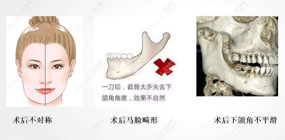 下颌角被切掉会出现哪些症状 下颌角被切掉会出现哪些症状